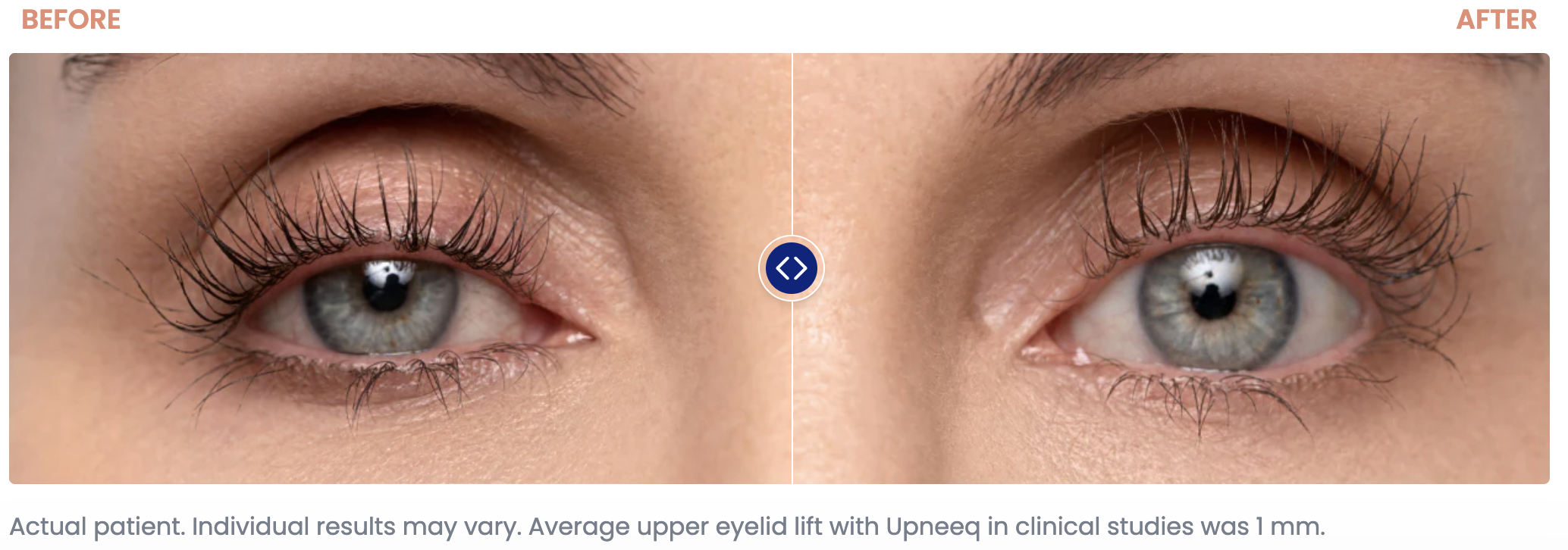 EYELID LIFT WITHOUT SURGERY Atkinson Eye Care Droopy IL