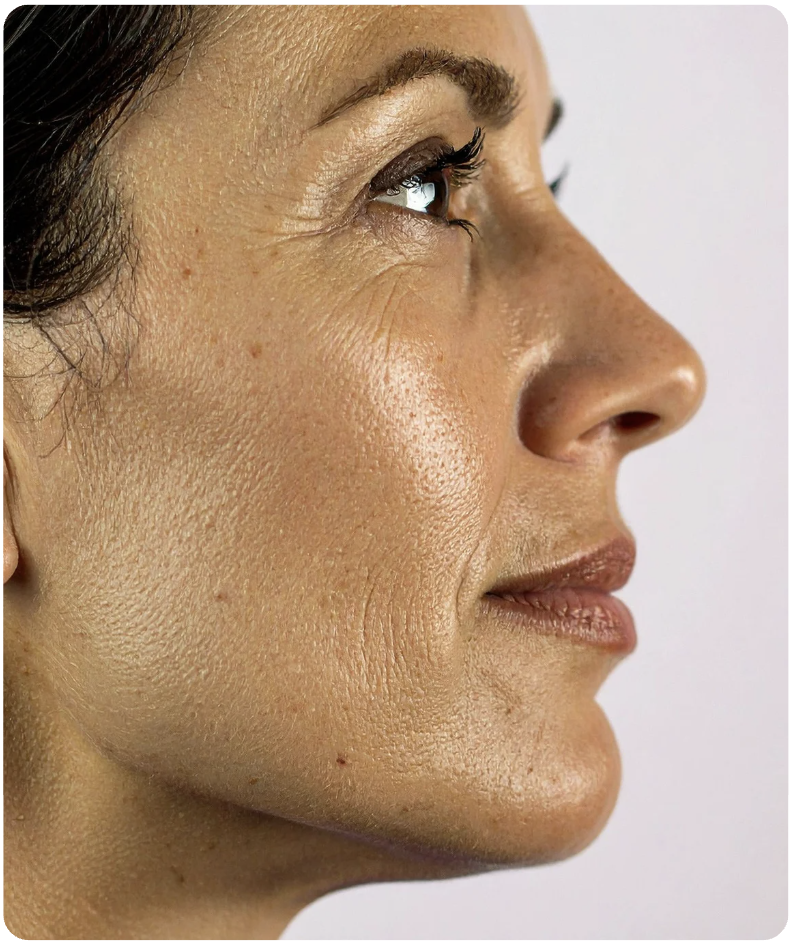 Meibomian Gland Dysfunction Algonquin atkinson Eye Care